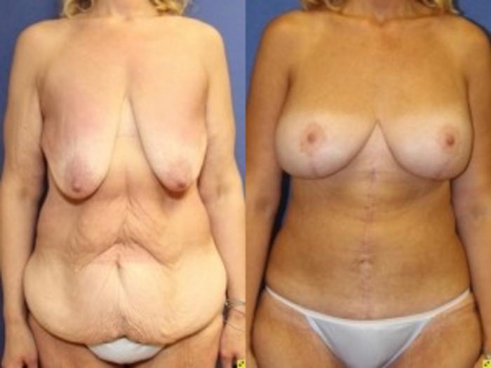 Before & After Panniculectomy Case 281 Front View in Ann Arbor, MI