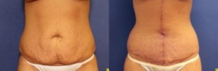 Before & After Panniculectomy Case 282 Front View in Ypsilanti, MI