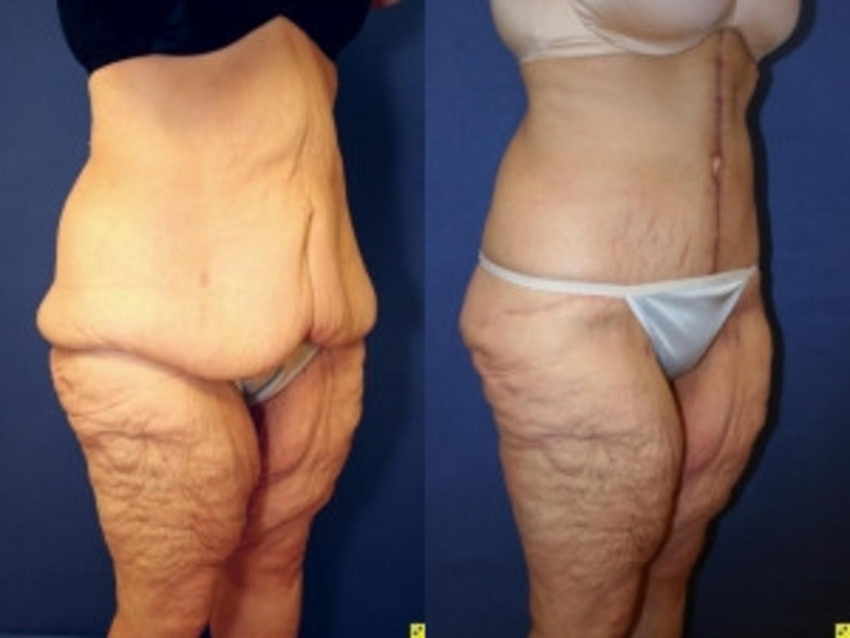 Before & After Panniculectomy Case 283 Right Oblique View in Ann Arbor, MI