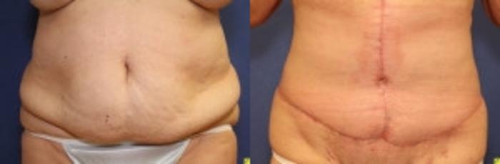 Before & After Panniculectomy Case 284 Front View in Ann Arbor, MI