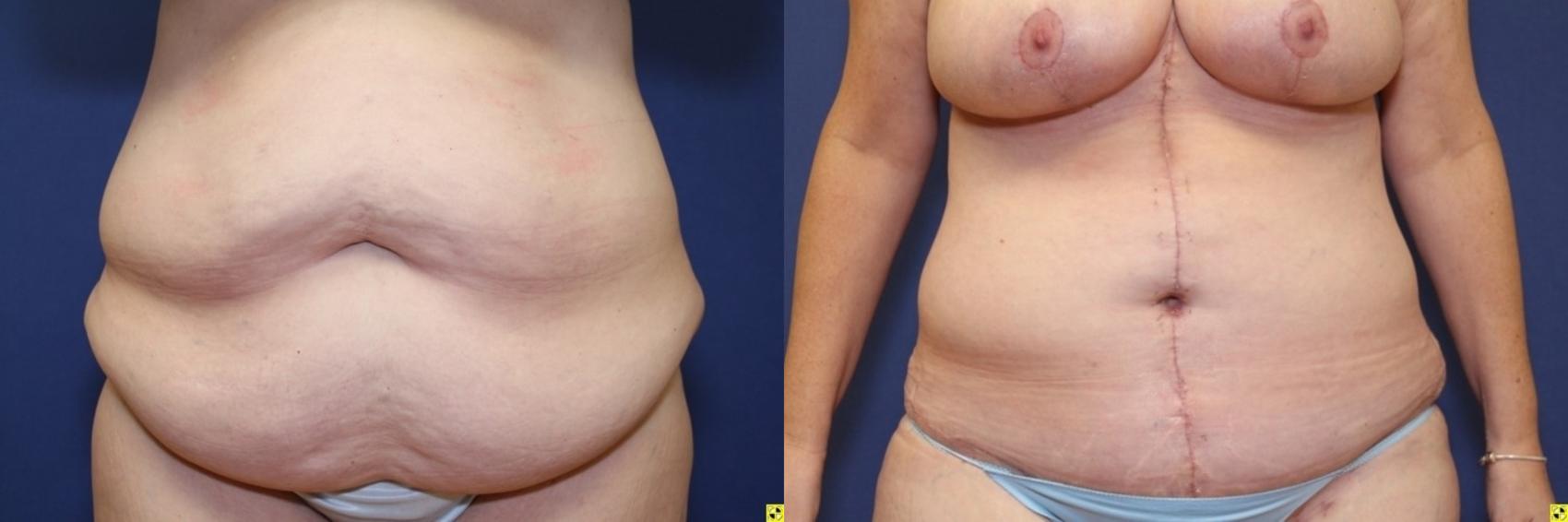 Before & After Panniculectomy Case 285 Front View in Ypsilanti, MI