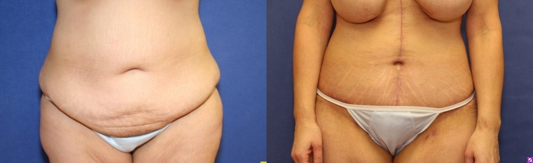 Before & After Panniculectomy Case 286 Front View in Ypsilanti, MI