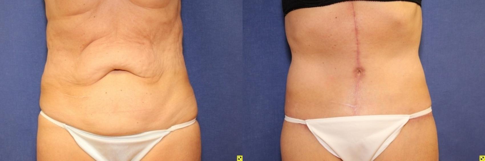 Before & After Panniculectomy Case 287 Front View in Ypsilanti, MI