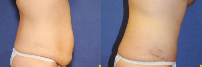 Before & After Panniculectomy Case 288 Right Side View in Ann Arbor, MI