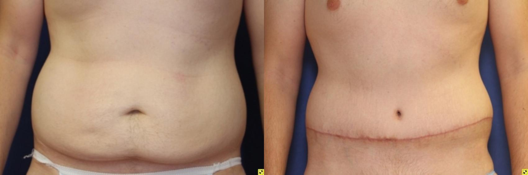 Before & After Panniculectomy Case 289 Front View in Ypsilanti, MI