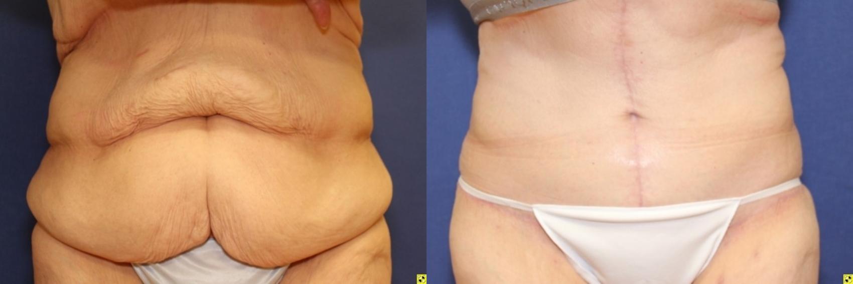 Before & After Panniculectomy Case 290 Front View in Ypsilanti, MI