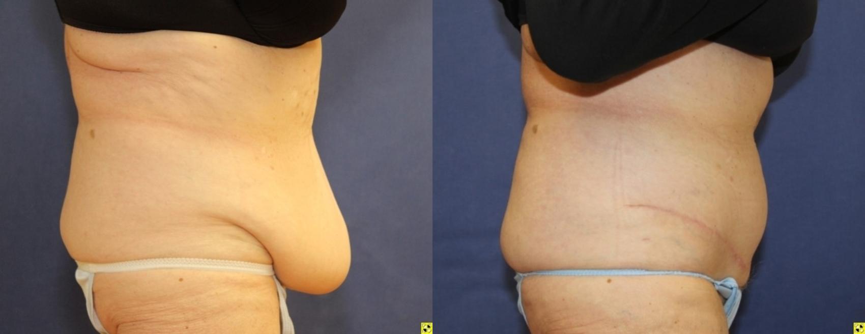 Before & After Panniculectomy Case 291 Right Side View in Ypsilanti, MI