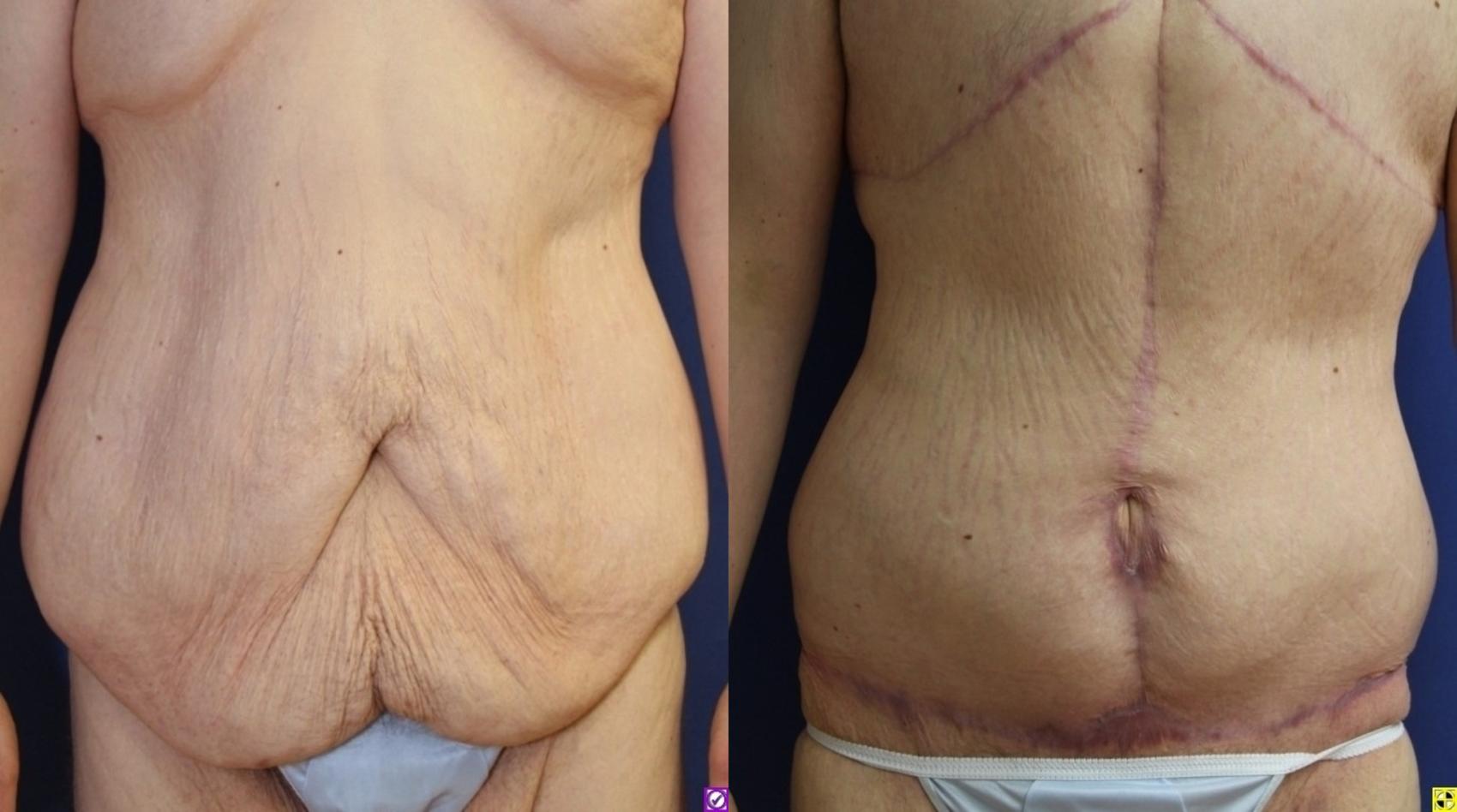 Before & After Panniculectomy Case 292 Front View in Ann Arbor, MI
