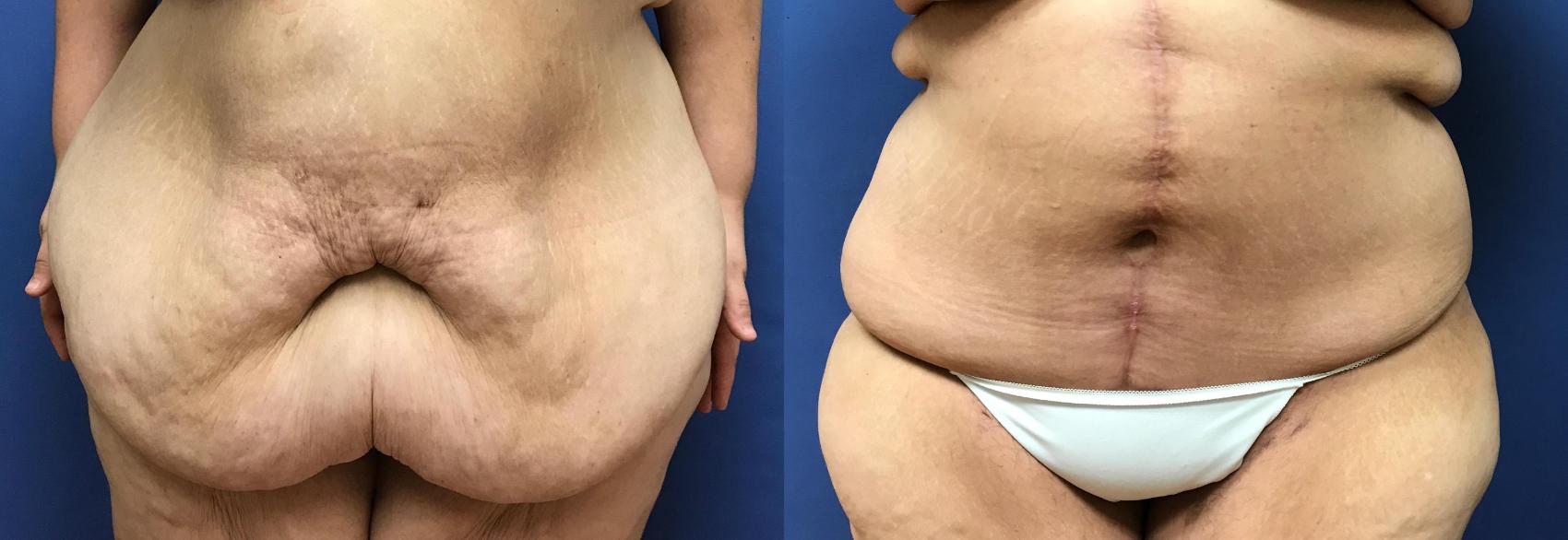 Before & After Panniculectomy Case 293 Front View in Ann Arbor, MI