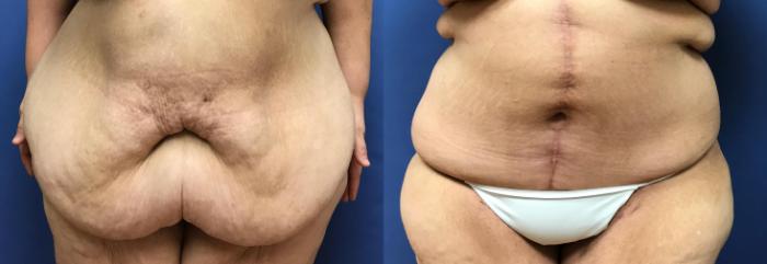 Before & After Panniculectomy Case 293 Front View in Ypsilanti, MI