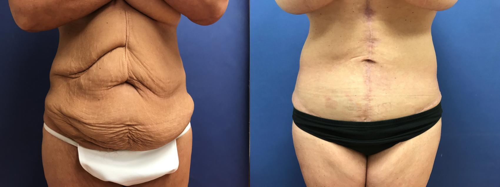 Before & After Panniculectomy Case 294 Front View in Ann Arbor, MI