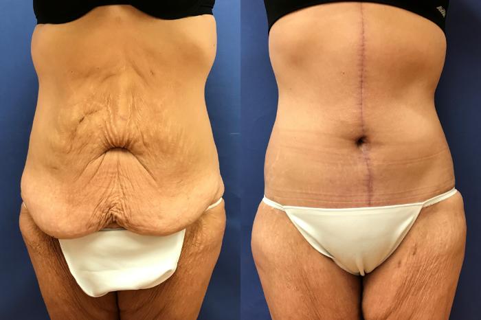 Before & After Panniculectomy Case 295 Front View in Ann Arbor, MI