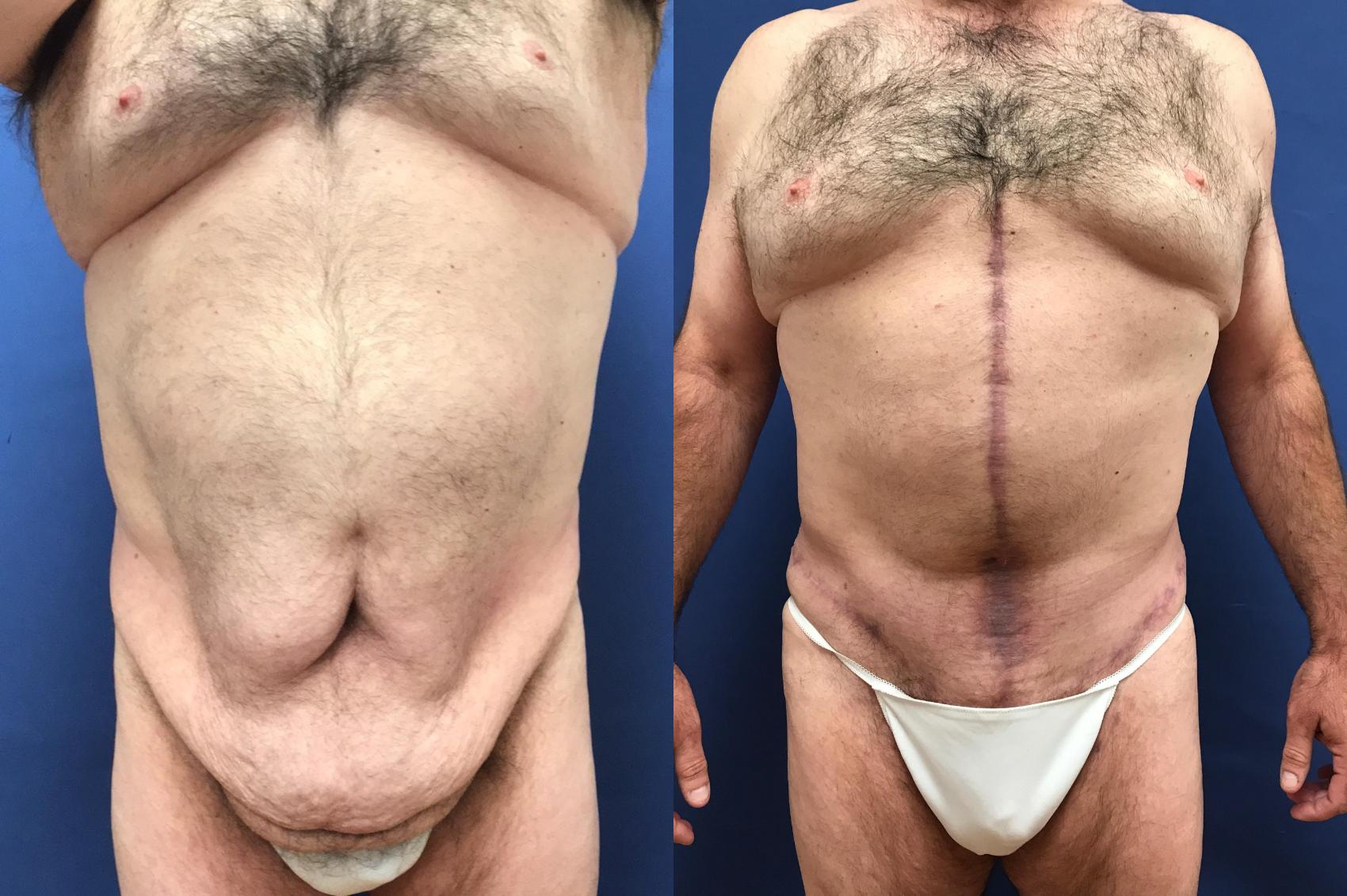 Before & After Panniculectomy Case 296 Front View in Ypsilanti, MI