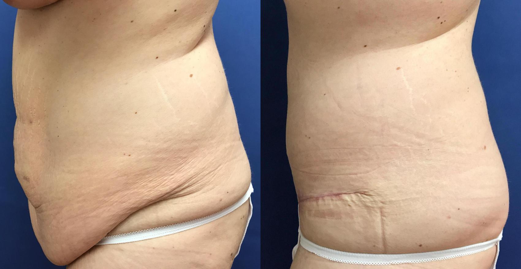 Before & After Panniculectomy Case 297 Left Side View in Ann Arbor, MI