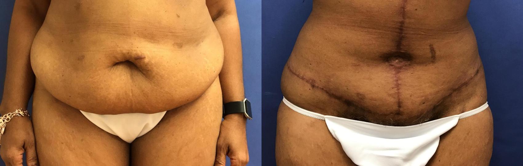 Before & After Panniculectomy Case 298 Front View in Ypsilanti, MI