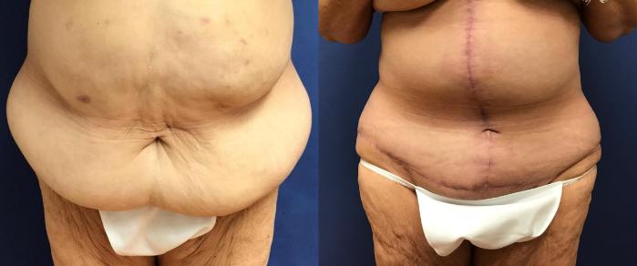 Before & After Panniculectomy Case 299 Front View in Ypsilanti, MI
