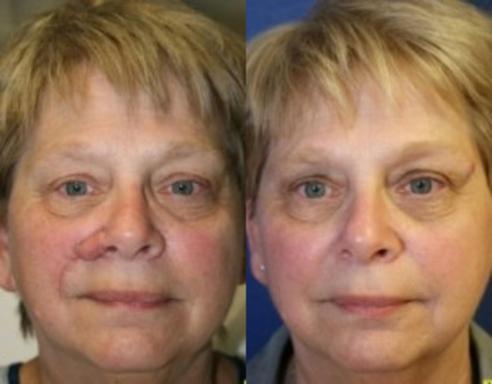 Before & After Rhinoplasty Case 159 Front View in Ann Arbor, MI