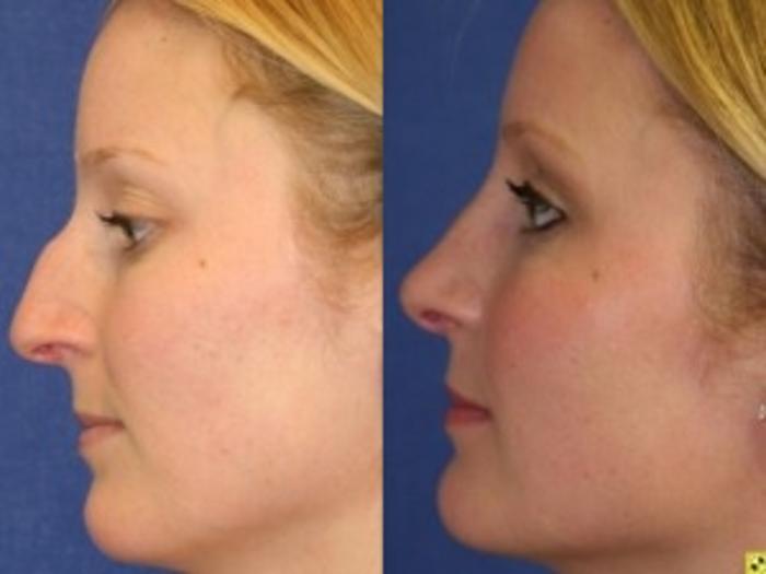 Before & After Rhinoplasty Case 161 Left Side View in Ypsilanti, MI