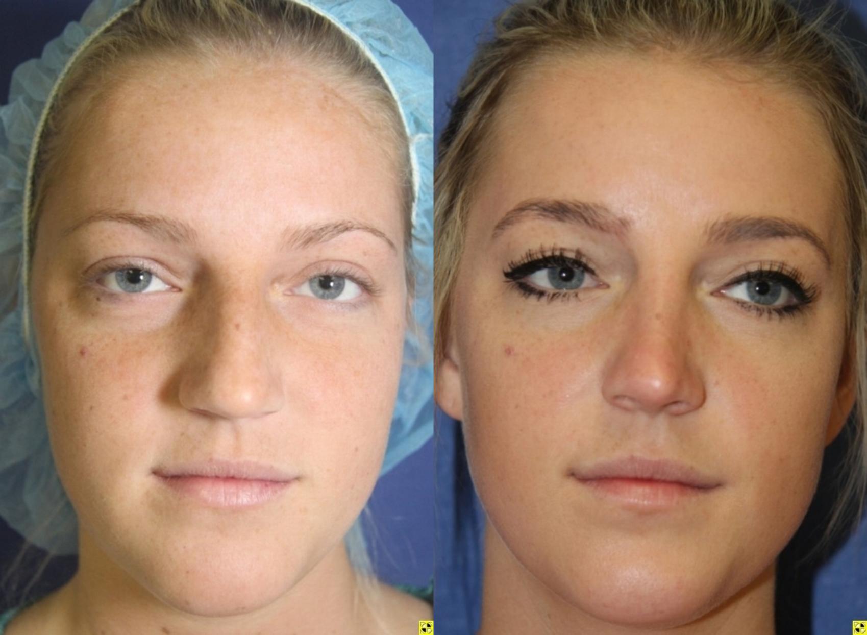 Before & After Rhinoplasty Case 162 Front View in Ypsilanti, MI