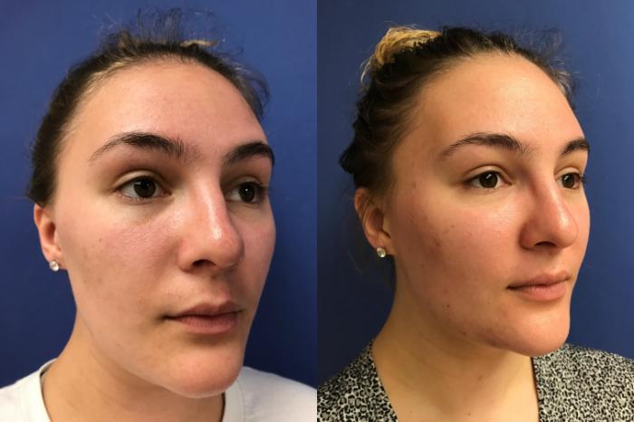 Before & After Rhinoplasty Case 163 Right Oblique View in Ypsilanti, MI