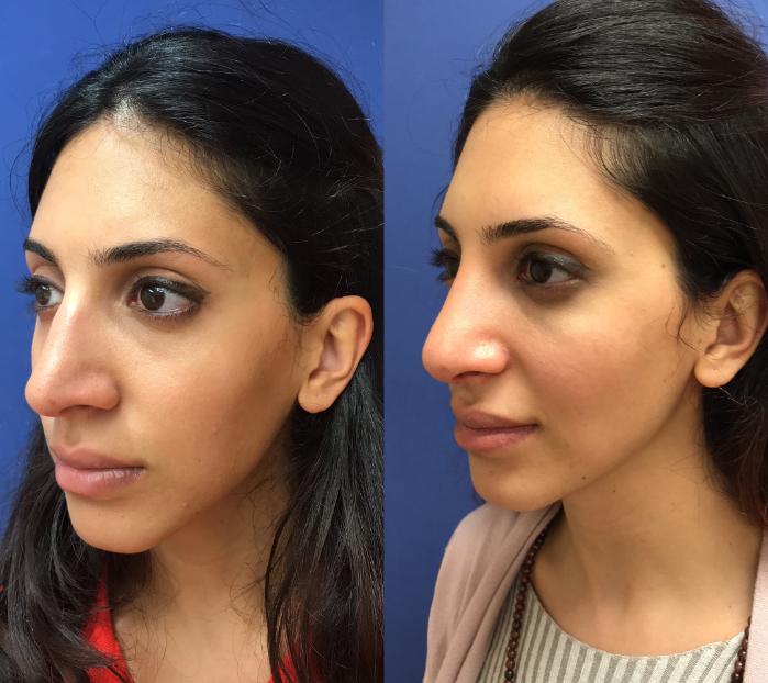Before & After Rhinoplasty Case 164 Left Oblique View in Ann Arbor, MI