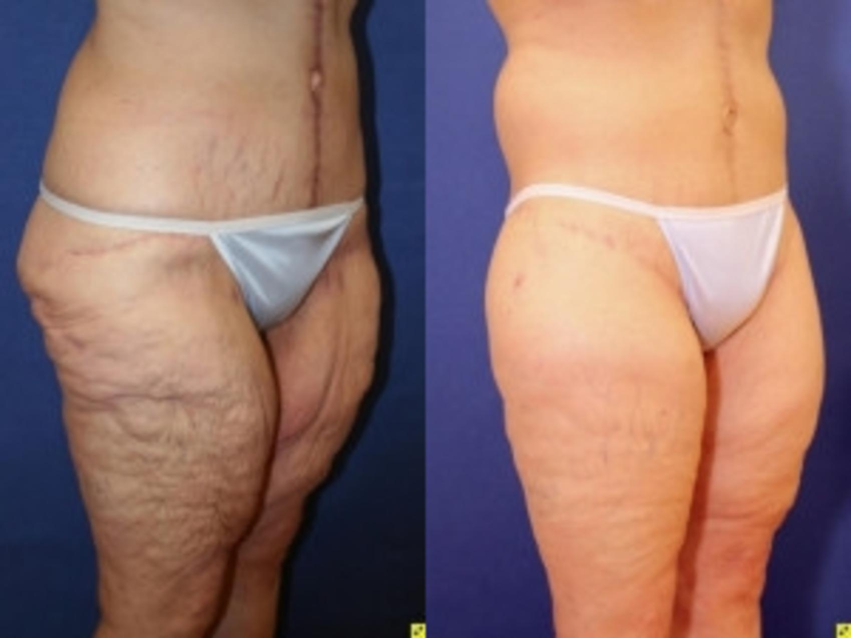 Before & After Thigh Lift Case 269 Right Oblique View in Ypsilanti, MI