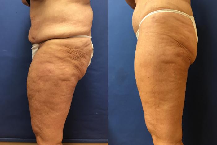 Before & After Thigh Lift Case 270 Left Side View in Ann Arbor, MI