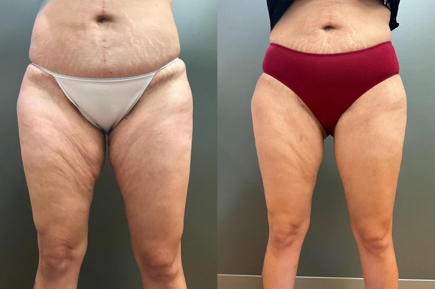 Before & After Thigh Lift Case 406 Front View in Ann Arbor, MI