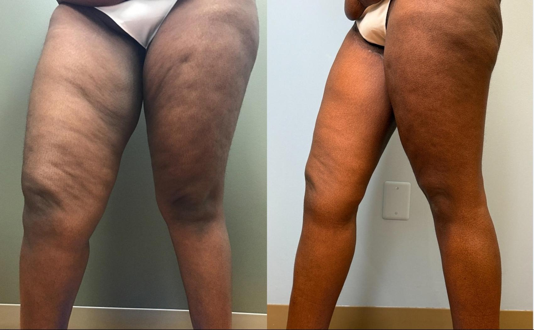 Before & After Thigh Lift Case 448 Left Side View in Ann Arbor, MI