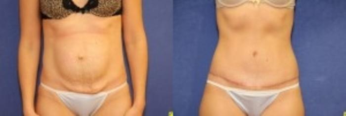 Before & After Tummy Tuck Case 238 Front View in Ypsilanti, MI