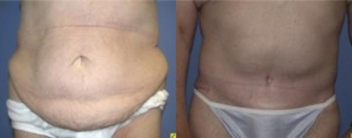 Before & After Tummy Tuck Case 239 Front View in Ypsilanti, MI