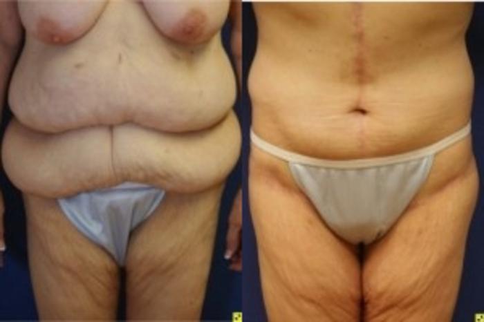 Before & After Tummy Tuck Case 240 Front View in Ypsilanti, MI