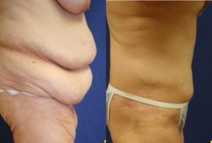 Before & After Body Contouring After Weight Loss Case 240 Right Side View in Ann Arbor, MI