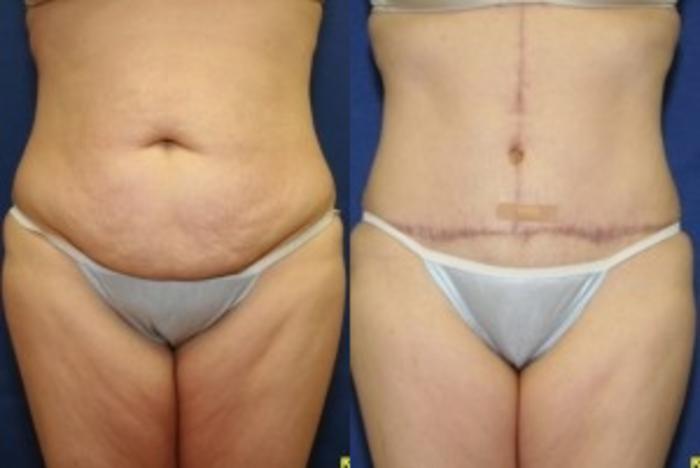 Before & After Tummy Tuck Case 241 Front View in Ypsilanti, MI