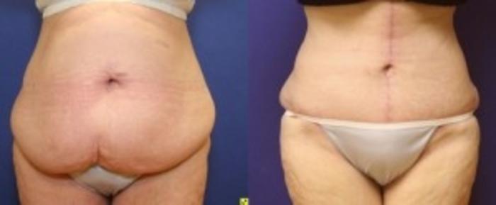 Before & After Body Contouring After Weight Loss Case 242 Front View in Ypsilanti, MI