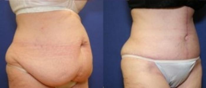 Before & After Tummy Tuck Case 242 Right Oblique View in Ann Arbor, MI