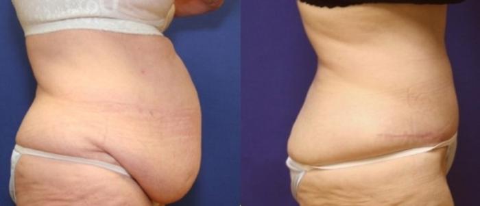 Before & After Body Contouring After Weight Loss Case 242 Right Side View in Ann Arbor, MI