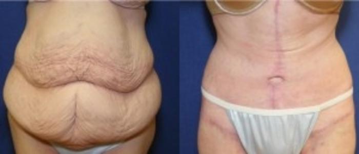 Before & After Tummy Tuck Case 243 Front View in Ann Arbor, MI