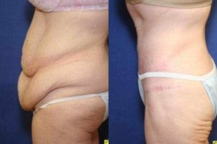 Before & After Body Contouring After Weight Loss Case 243 Left Side View in Ann Arbor, MI