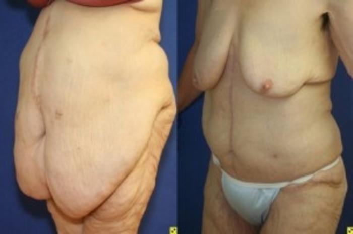 Before & After Tummy Tuck Case 244 Left Oblique View in Ann Arbor, MI