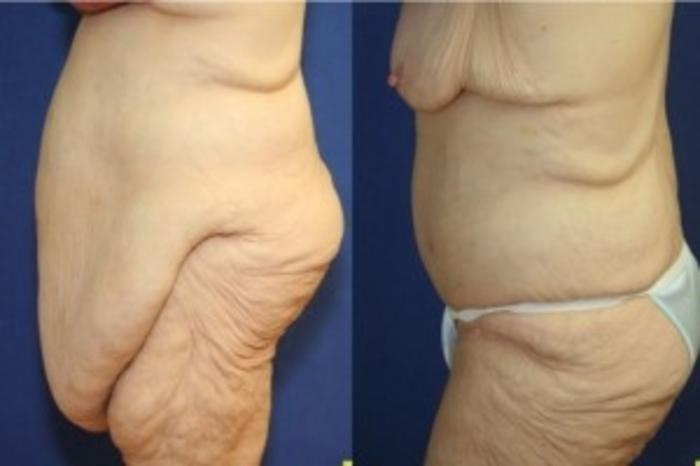 Before & After Tummy Tuck Case 244 Left Side View in Ann Arbor, MI