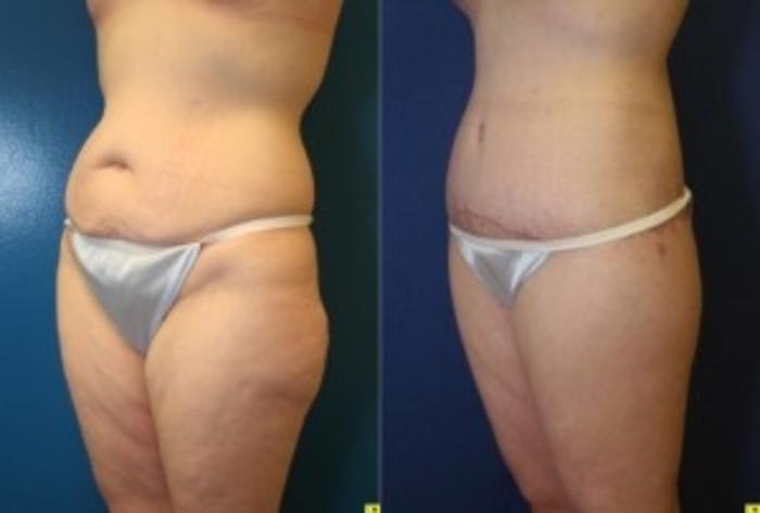 Before & After Tummy Tuck Case 245 Left Oblique View in Ypsilanti, MI