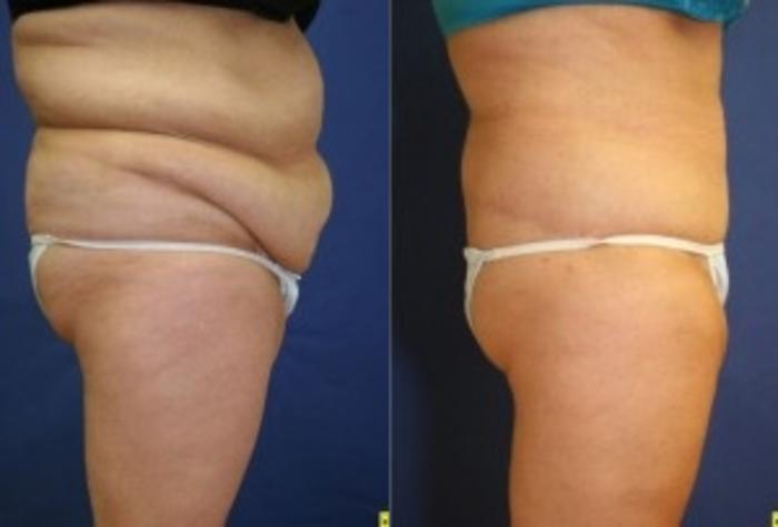 Before & After Body Contouring After Weight Loss Case 246 Right Side View in Ann Arbor, MI