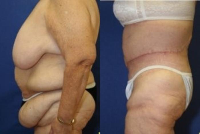 Before & After Body Contouring After Weight Loss Case 247 Left Side View in Ann Arbor, MI