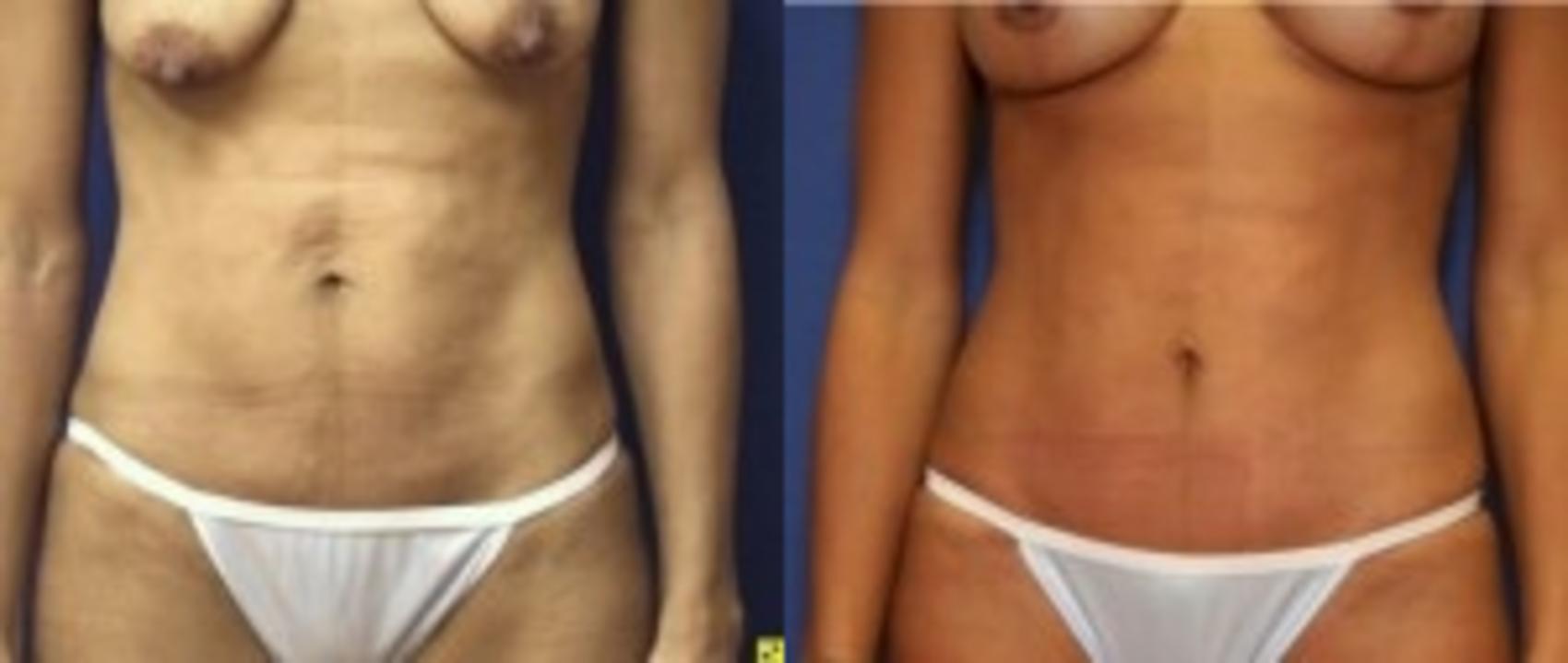 Before & After Tummy Tuck Case 248 Front View in Ann Arbor, MI