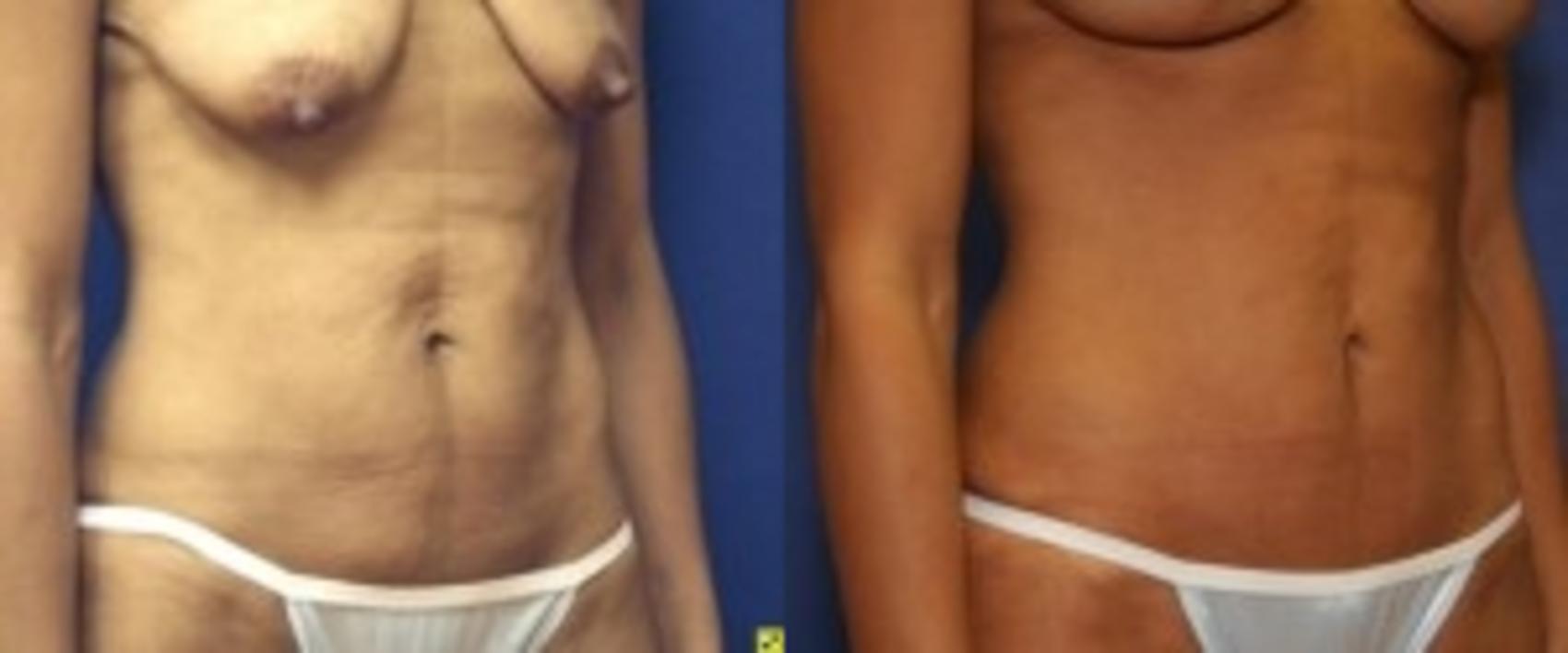 Before & After Tummy Tuck Case 248 Right Oblique View in Ann Arbor, MI