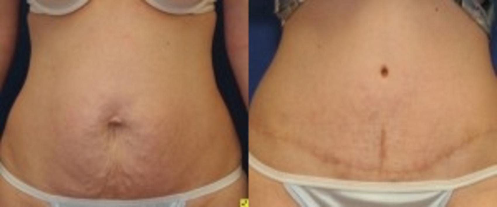 Before & After Tummy Tuck Case 249 Front View in Ann Arbor, MI