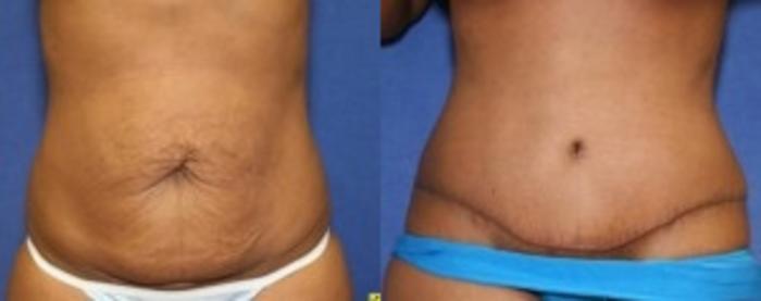 Before & After Tummy Tuck Case 250 Front View in Ypsilanti, MI