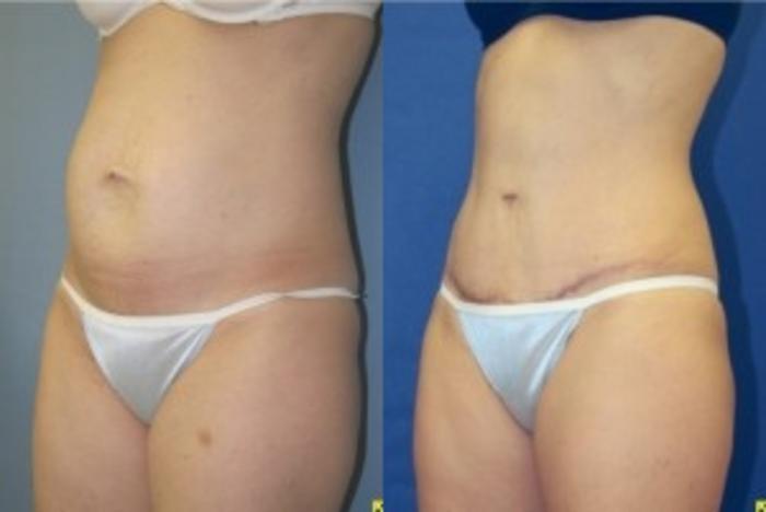 Before & After Tummy Tuck Case 251 Left Oblique View in Ann Arbor, MI