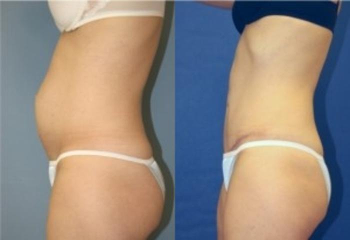 Before & After Tummy Tuck Case 251 Left Side View in Ypsilanti, MI